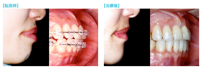 矯正の再治療症例