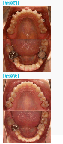 矯正再治療の前後