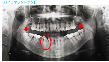 パノラマレントゲン