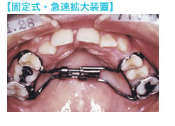 急速拡大装置