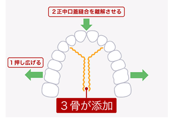 上顎骨拡大の仕組み