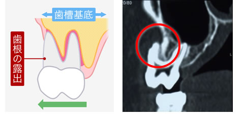 歯根露出のCT画像と図