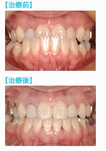 矯正再治療の前後