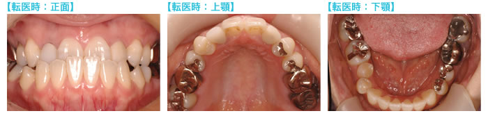 転院時の歯並び