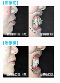 矯正再治療の前後