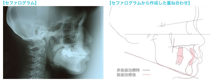 セファログラムの重要性