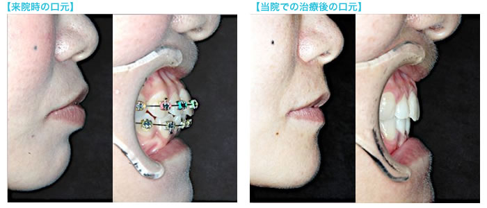 来院時と再治療後の口元
