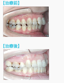 矯正再治療の前後