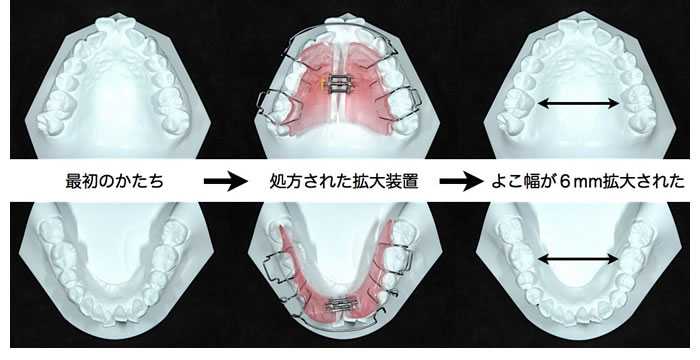 床矯正による横幅の拡大