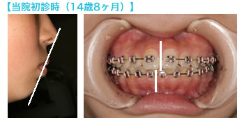 初診時の歯並び