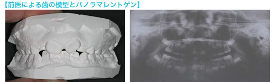 再治療前の歯の模型とパノラマレントゲン
