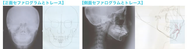 セファログラムとトレース