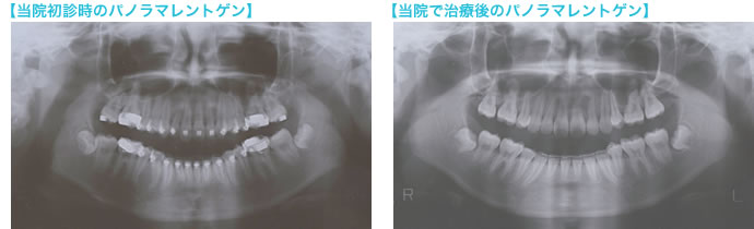 初診時と再治療後のパノラマレントゲン