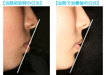 初診時と再治療後の口元