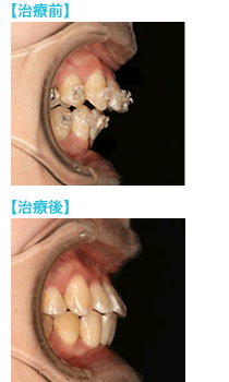 矯正再治療の前後