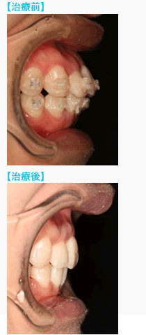 矯正再治療の前後