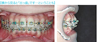 矯正治療例の掲載