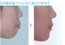矯正治療例の口元