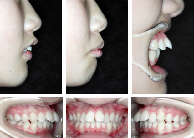 出っ歯の治療前 口元と歯並び