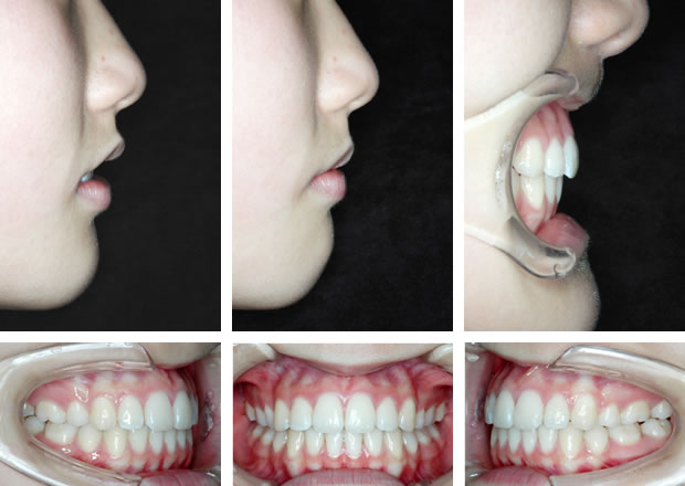 出っ歯の治療後 口元と歯並び