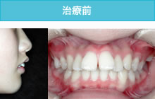 出っ歯の治療前