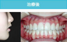 出っ歯の治療後