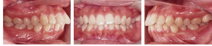 両突歯列の治療前 歯並び