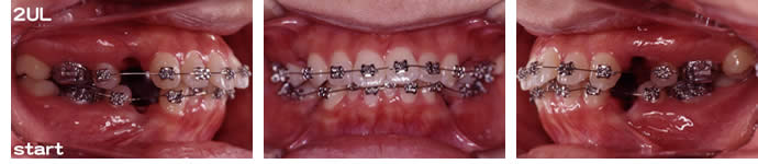 両突歯列の治療 装置装着後 歯並び