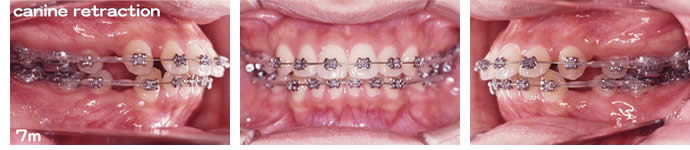両突歯列の治療７か月後 歯並び