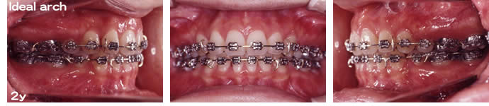 両突歯列の治療 2年後 歯並び