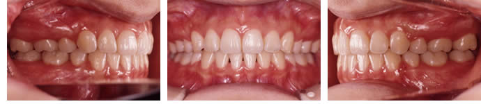 両突歯列の治療後 歯並び