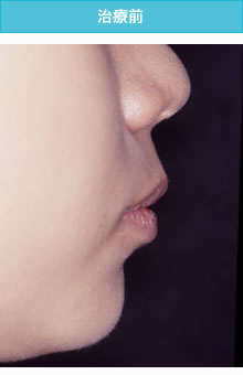 両突歯列の治療前