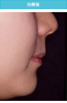 両突歯列の治療後