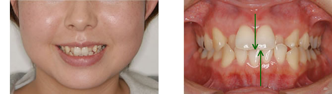 両突歯列の治療前 口元と歯並び