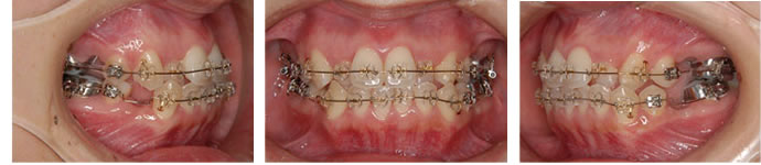 両突歯列の治療 装置装着後 歯並び