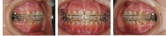 両突歯列の治療中 18ヶ月後 歯並び