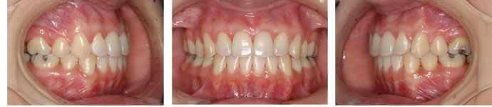 両突歯列の治療後 歯並び