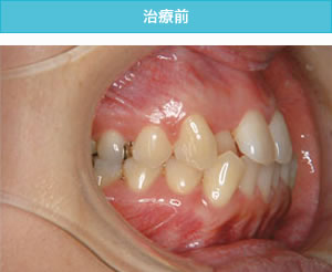 両突歯列の治療前