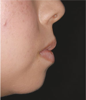 両突歯列の治療前 口元