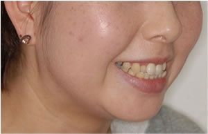 両突歯列の治療前 歯並び 横