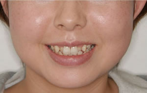 両突歯列の治療前 歯並び 正面