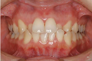 両突歯列の治療前 歯並び