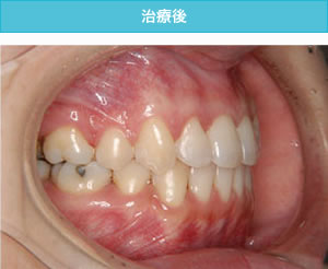 両突歯列の治療後