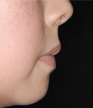 両突歯列の治療後 口元