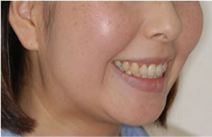 両突歯列の治療後 歯並び 横