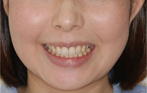 両突歯列の治療後 歯並び 正面