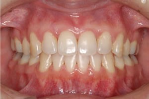 両突歯列の治療後 歯並び