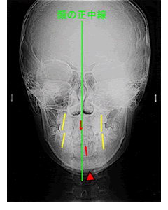 治療前の正面セファログラム