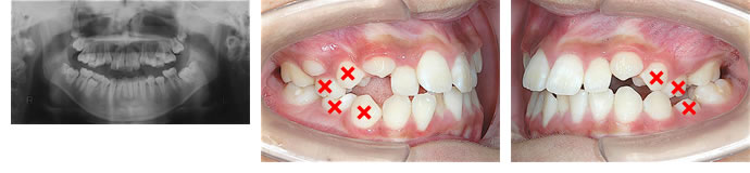 偏位咬合の歯並びと抜歯箇所