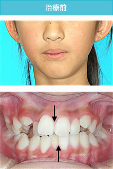 偏位咬合の治療前